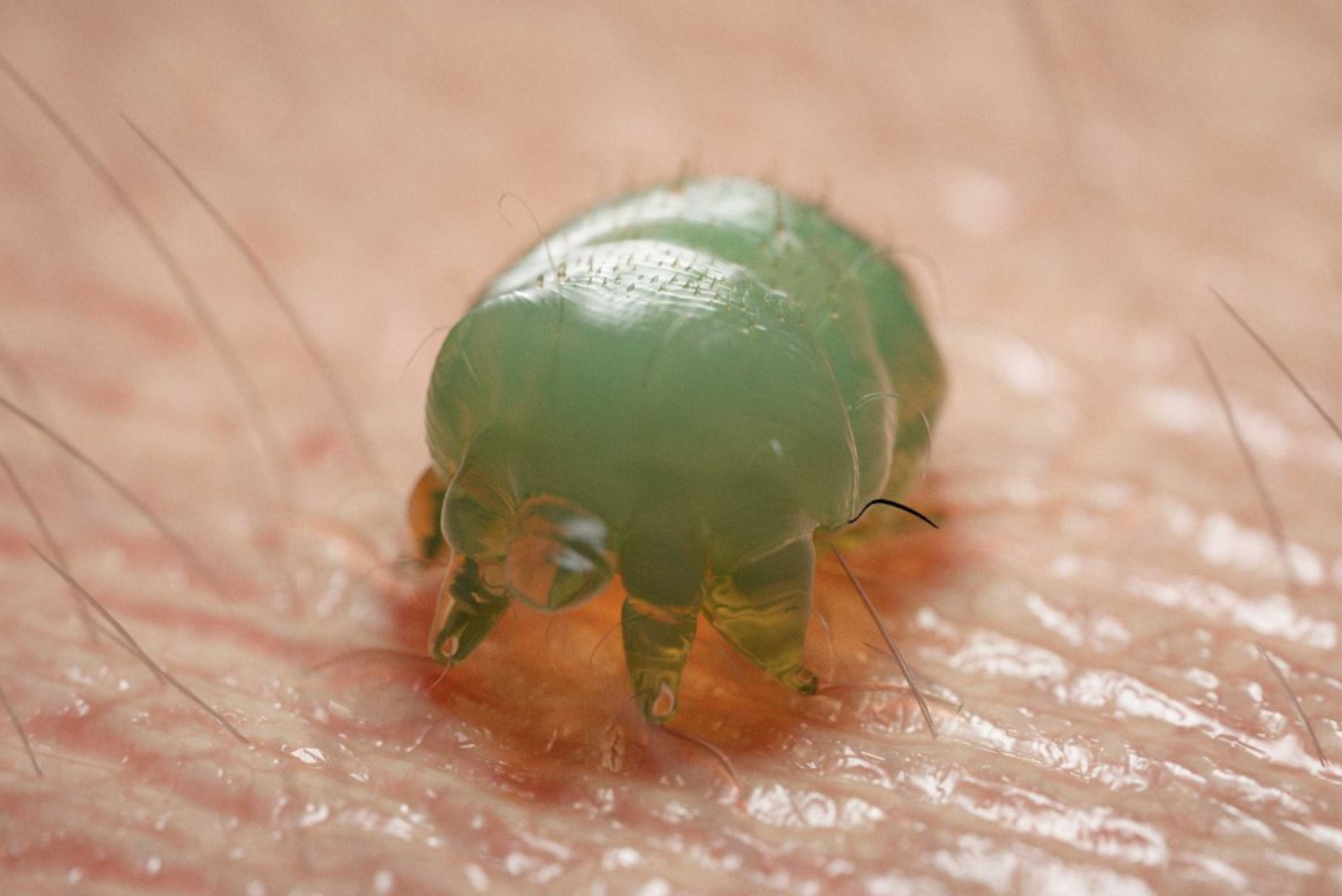 Why Does Scabies Itch So Much?